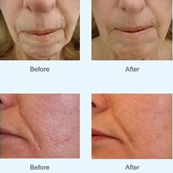 before and after micro needling
