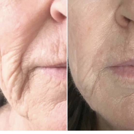 Used Skin rejuvenation