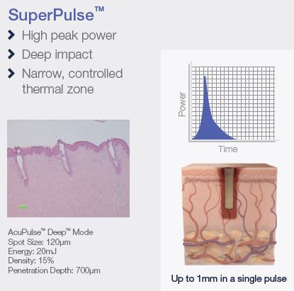 SuperPulse TM