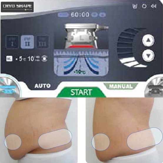 used Cryoshape body countouring